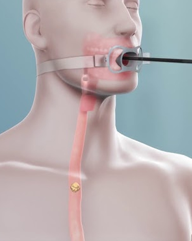 FOREIGN BODY REMOVAL